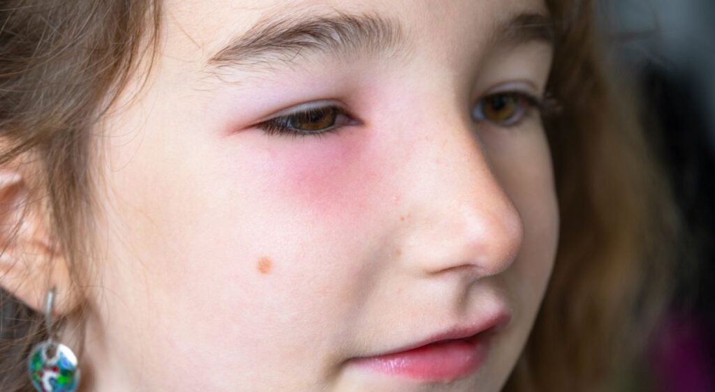 Piqure de Guepe que faire