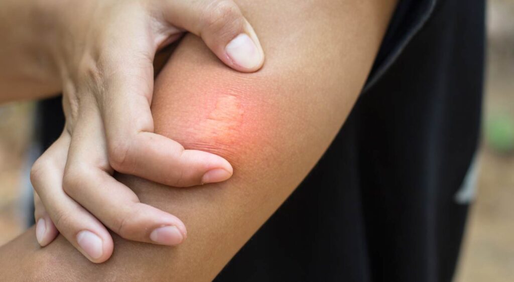 piqûre de frelon gonflement le lendemain